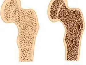 Osteoporosis treatment in pune