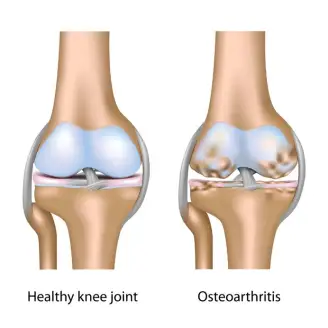 Osteoarthritis