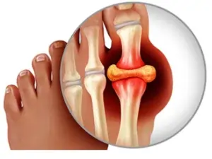 Gout treatment in pune