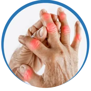 Psoriatic Arthritis Treatment in Pune