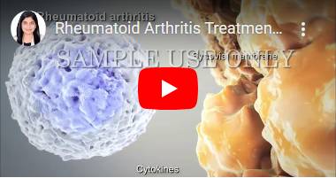 Rheumatoid Arthritis Treatment in Pune | Dr. Laxmi Waprani